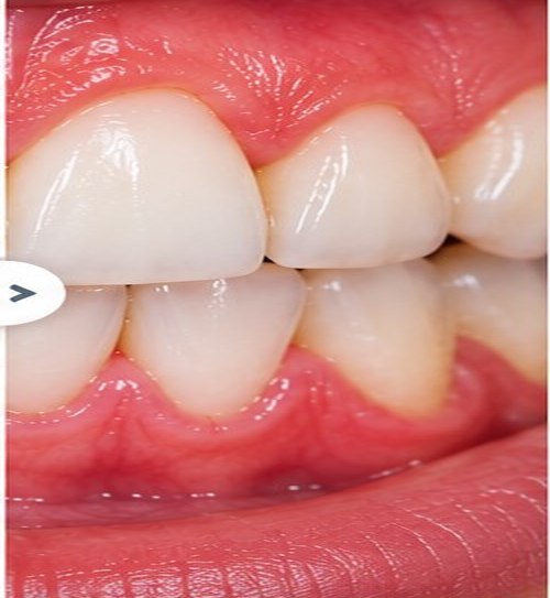 Illustrative after view for Scaling (Deep Cleaning)