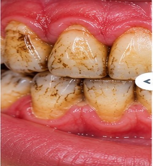 Illustrative before view for Scaling (Deep Cleaning)