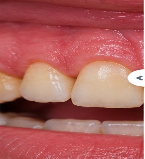 Illustrative before view for Crown Lengthening