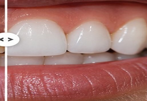 Illustrative after view for Composite Veneers