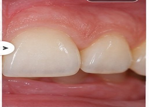 Illustrative after view for Gum Depigmentation