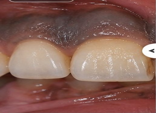 Illustrative before view for Gum Depigmentation