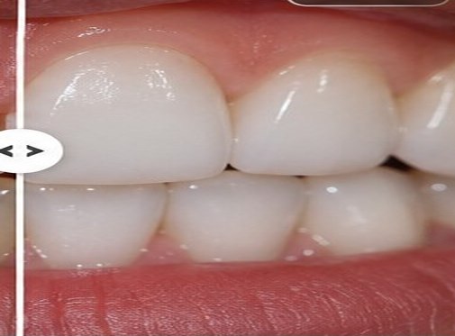 Illustrative after view for Tooth Bonding (Composite)