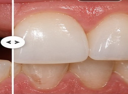 Illustrative after view for Dental Implants