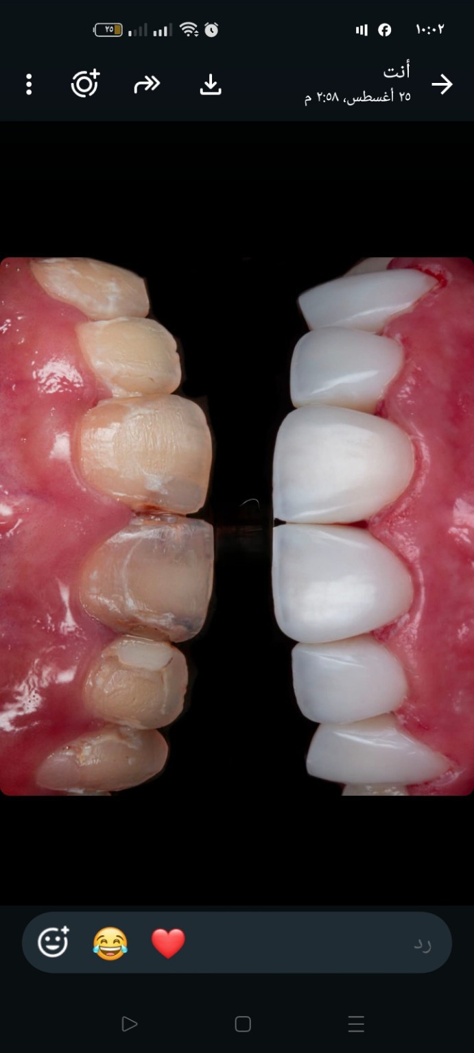 Patient dental smile case 2 at Care Plus Dental Clinic in Hurghada