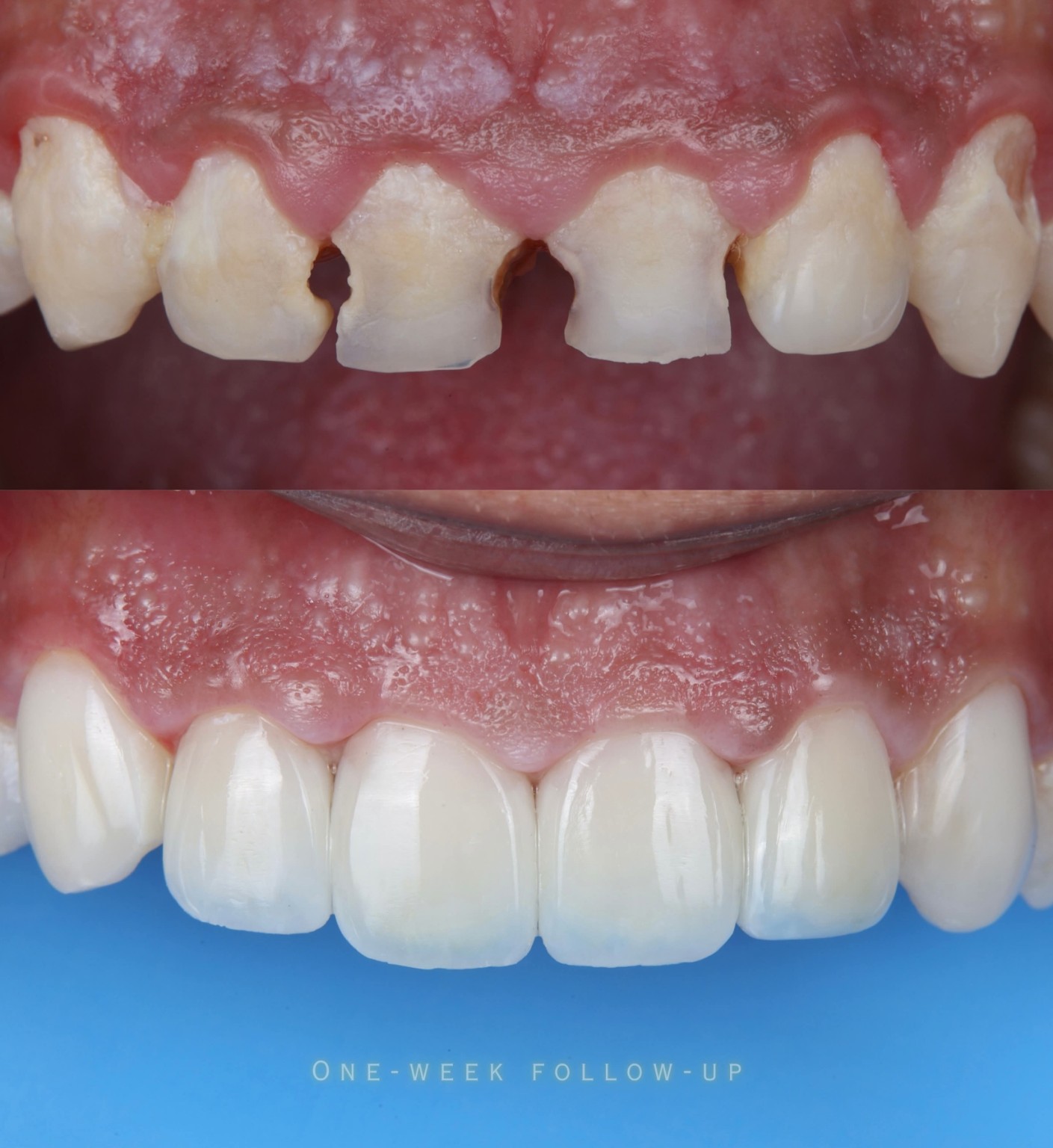 Patient dental smile case 3 at Care Plus Dental Clinic in Hurghada