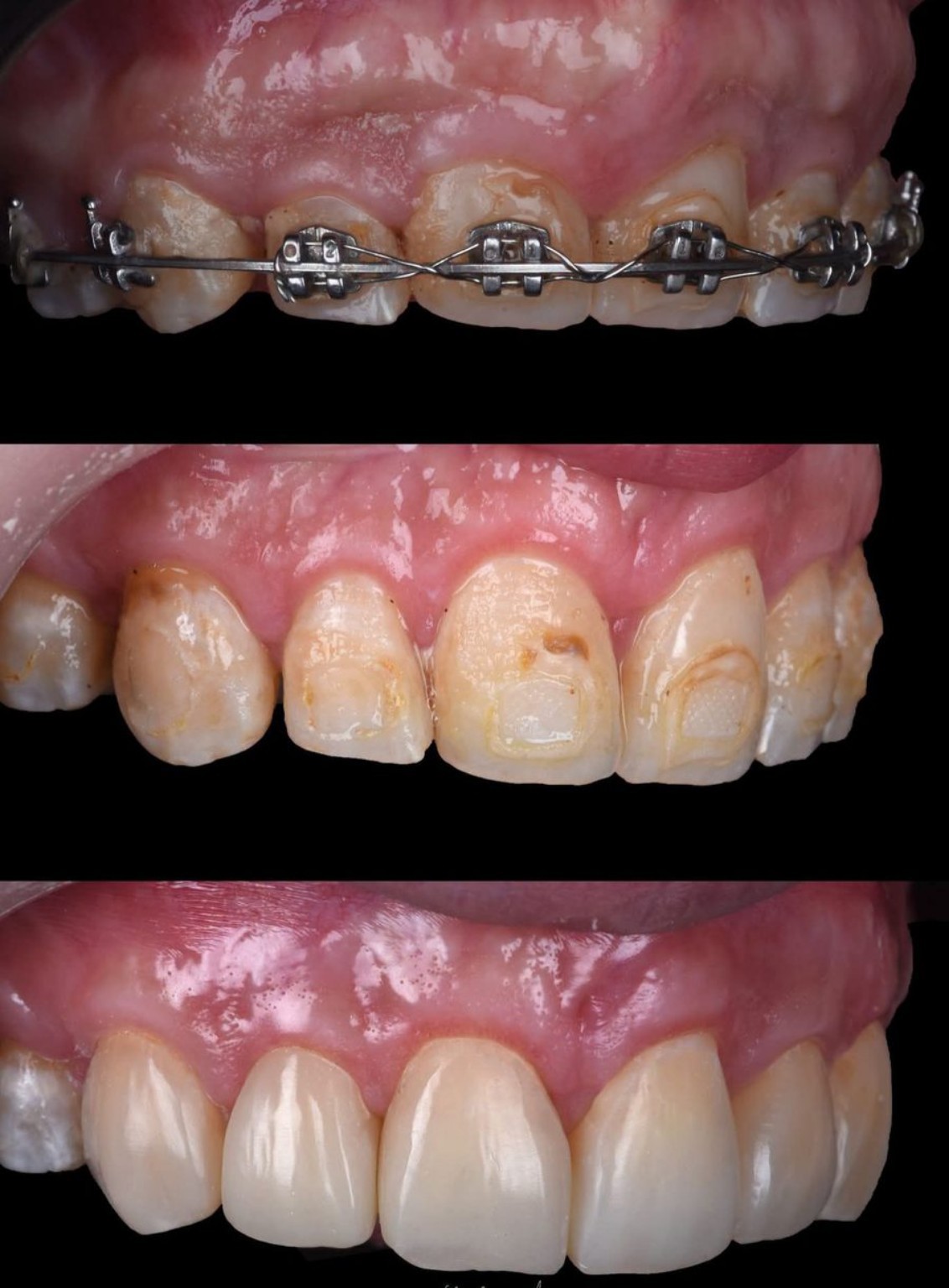 Patient dental smile case 4 at Care Plus Dental Clinic in Hurghada
