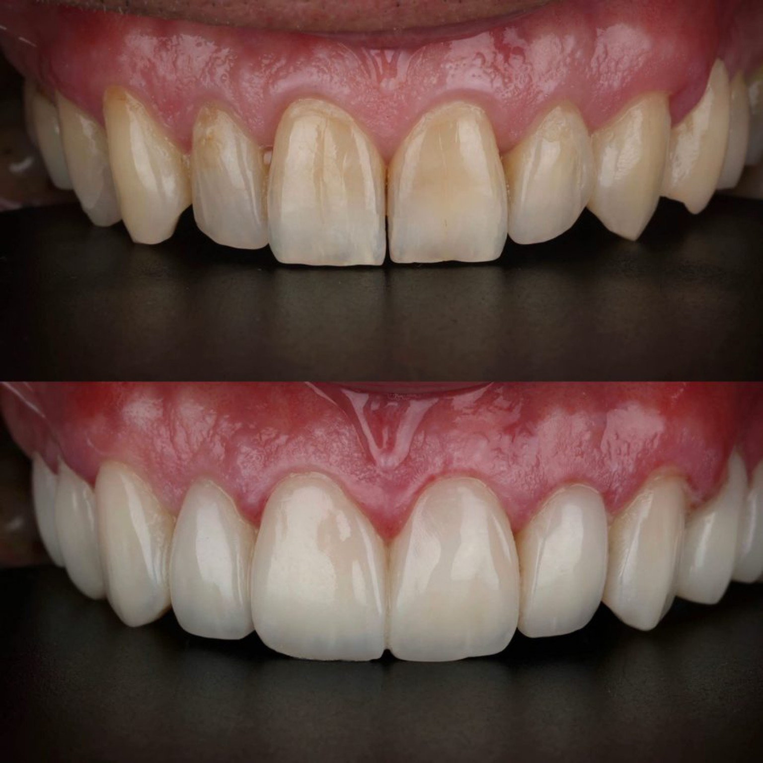 Patient dental smile case 7 at Care Plus Dental Clinic in Hurghada