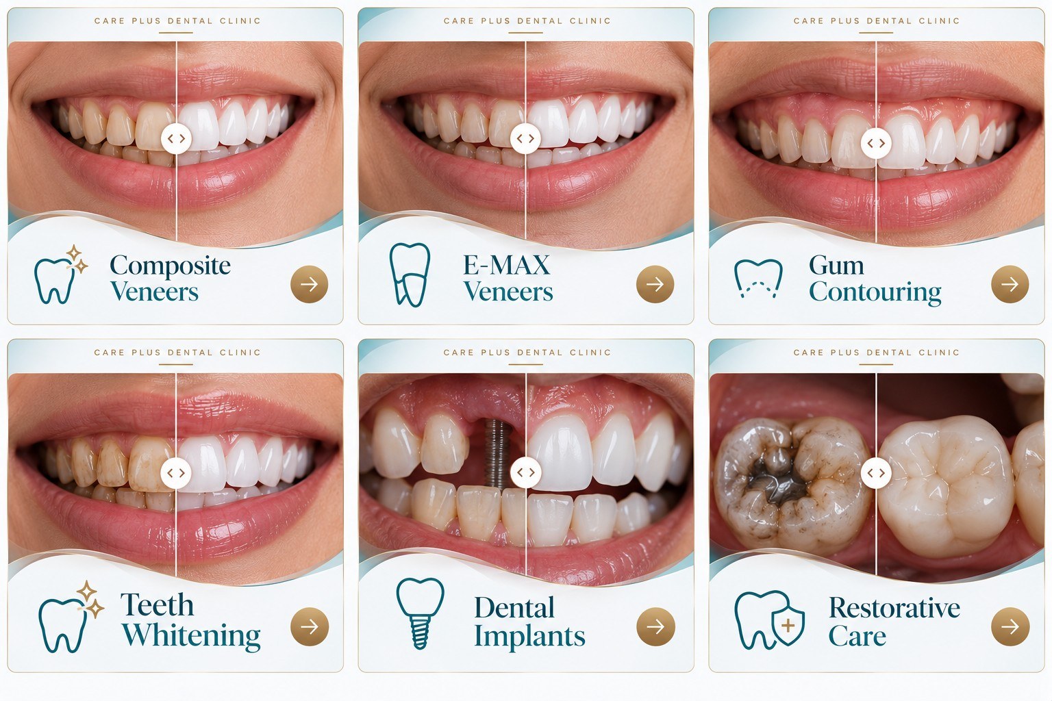 Composite veneers, E-max veneers, gum contouring, whitening, implants and restorative care